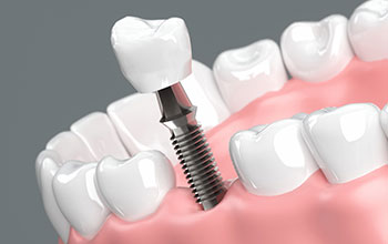 インプラント無料カウンセリング