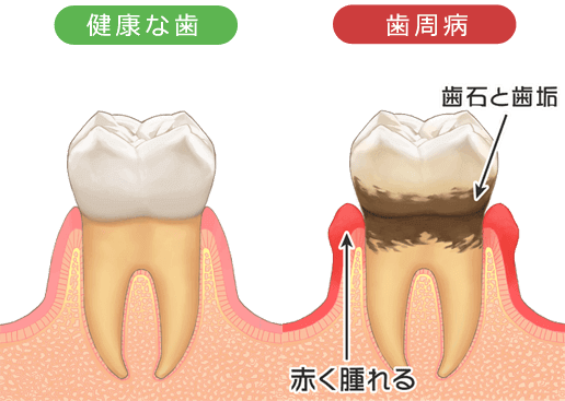 歯ぐきが腫れた原因や治療法 吹田市のクリニックまつもと歯科