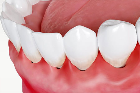 歯ぐきが腫れた