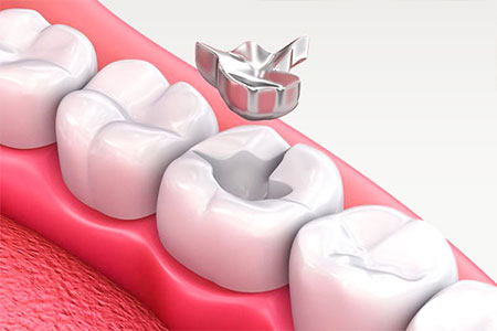 詰め物・かぶせ物が取れた