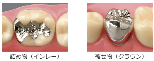 詰め物とかぶせ物