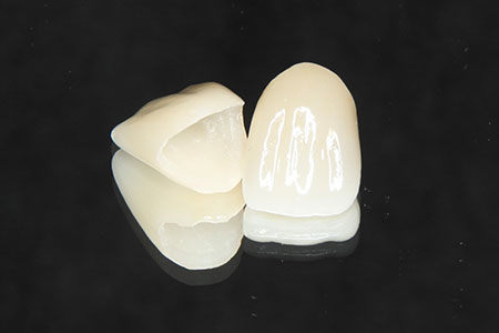 上部構造(かぶせ物)