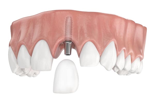 前歯のインプラント