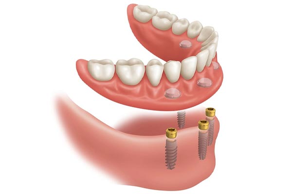 インプラントオーバーデンチャー