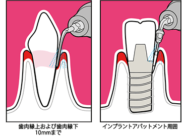 スマートピエゾンとPSチップ図解