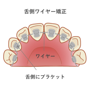 子供の受け口矯正に使うチンキャップ 効果 費用などまとめ 歯科衛生士がお口の悩みに答えます