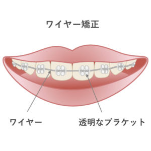 子供の受け口矯正に使うチンキャップ 効果 費用などまとめ 歯科衛生士がお口の悩みに答えます