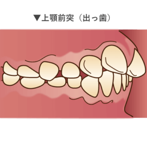 子供の歯並びが悪くなる 直すべき癖5選 歯科衛生士がお口の悩みに答えます