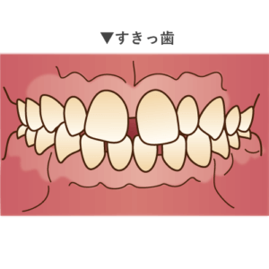 子供の前歯に見られる歯並び4選 原因と対処法 歯科衛生士がお口の悩みに答えます