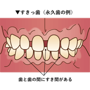 乳歯の歯並びが良い 悪いとは 前歯が斜めに生えてきたら