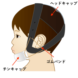 子供の受け口矯正に使うチンキャップ 効果 費用などまとめ 歯科衛生士がお口の悩みに答えます