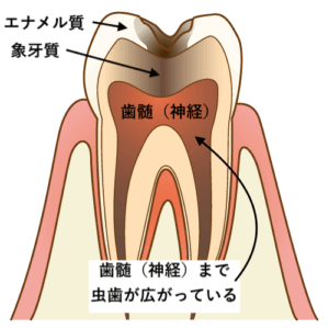 虫歯治療のうち神経の治療方法 流れまとめ 歯科衛生士がお口の悩みに答えます