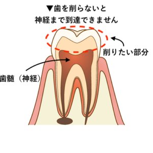 虫歯治療のうち神経の治療方法 流れまとめ 歯科衛生士がお口の悩みに答えます