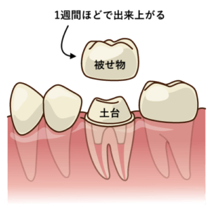 歯の被せ物の治療方法 流れまとめ 歯科衛生士がお口の悩みに答えます