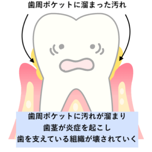 その口臭 原因は歯です 原因 対処法4選 歯科衛生士がお口の悩みに答えます